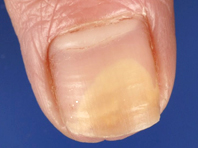 Дистальный вид грибка на ногтях