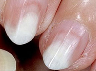 Поверхностный белая форма грибка на ногтях